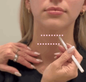 platysma botox